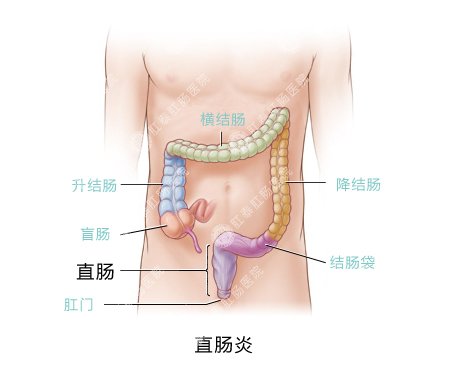 直肠炎