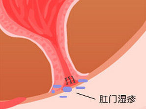 在福州治肛门湿疹的方法是哪些？